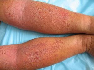 亞急性濕疹針狀