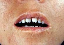 先天性梅毒牙 先天性梅毒牙