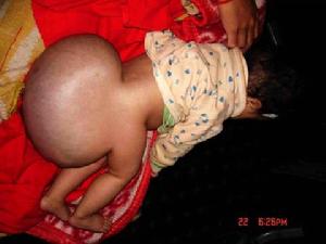 脊膜膨出與脊膜脊髓膨出