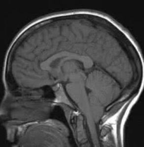 小腦扁桃體疝 小腦扁桃體疝