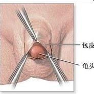 保膽取息肉 保膽取息肉
