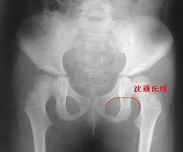 沈通氏線 沈通氏線