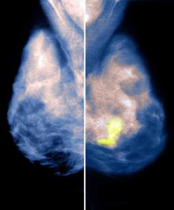 乳房攝影術 乳房攝影術