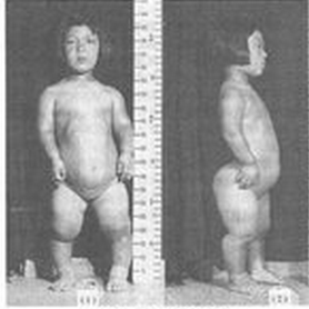 脛骨內髁骨軟骨病