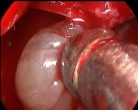 上頜竇囊腫 上頜竇囊腫