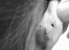 耳廓耳道撕裂傷 耳廓耳道撕裂傷