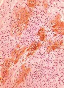 外陰纖維瘤 外陰纖維瘤