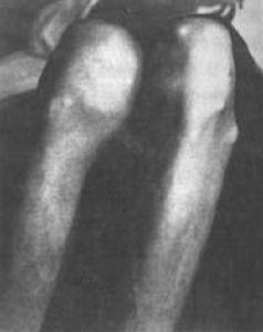 痛風及高尿酸血症 痛風及高尿酸血症