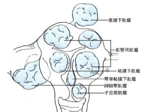子宮肌瘤蒂扭轉 子宮肌瘤蒂扭轉