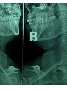 椎動脈型頸椎病 椎動脈型頸椎病