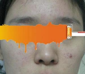 網友親曬擦拭“可蕊兒”後皮膚過敏