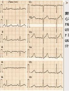 房室傳導阻滯 房室傳導阻滯