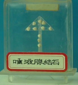 唾液腺結石 唾液腺結石