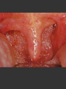 慢性單純性咽炎
