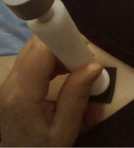 同位素治療 同位素治療