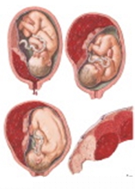 胎盤的過早分離
