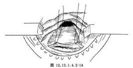 經肛門直腸黏膜及內括約肌切除術 經肛門直腸黏膜及內括約肌切除術