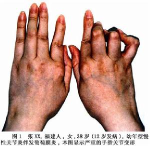 幼年型慢性關節炎及其伴發的葡萄膜炎 幼年型慢性關節炎及其伴發的葡萄膜炎