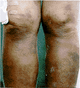 （圖）皮膚白血病