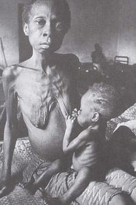 蛋白質—能量營養不良症