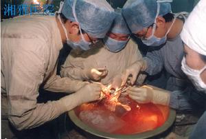 肝移植術