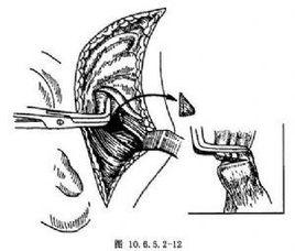 關節盤復位術 關節盤復位術