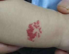 面部血管瘤