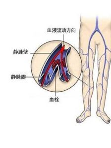 大隱靜脈曲張 大隱靜脈曲張