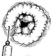 痔核脫出 痔核脫出