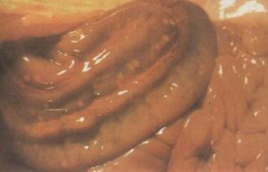 在結腸黏膜表面可見有小豆大隆起的結節