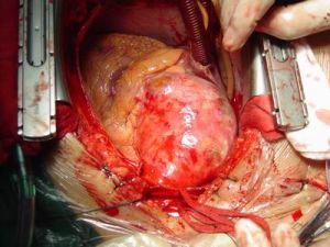 胸主動脈夾層動脈瘤