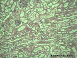 肝源性水腫 肝源性水腫