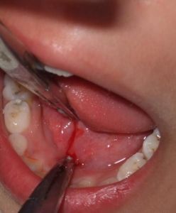 舌系帶過短手術治療