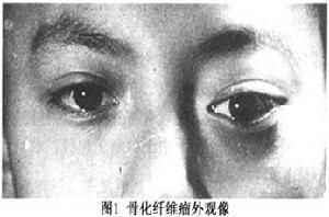 眼眶骨化纖維瘤