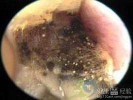 黴菌性外耳道炎