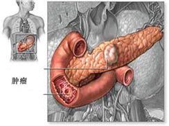卓-艾氏綜合症 卓-艾氏綜合症