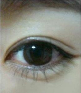 微創雙眼皮手術 微創雙眼皮手術