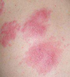 血熱型牛皮癬 血熱型牛皮癬