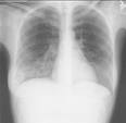 肺部先天性疾病