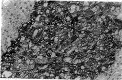 急性腎小球腎炎