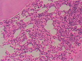 急性粒細胞白血病 急性粒細胞白血病