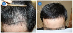 PRE修復植髮技術 PRE修復植髮技術