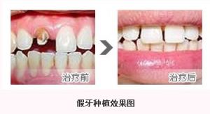 假牙種植效果圖