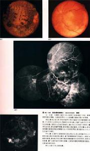 脈絡膜視網膜炎 脈絡膜視網膜炎
