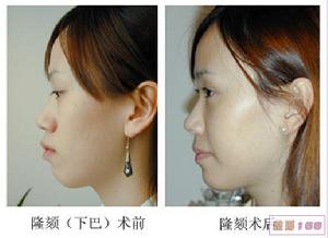下巴整形