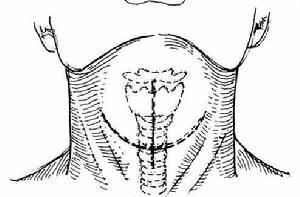 氣管楔狀切除吻合術 氣管楔狀切除吻合術