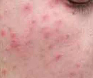 面部過敏性皮炎 面部過敏性皮炎