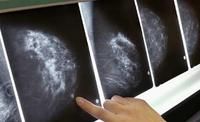 早期乳腺癌