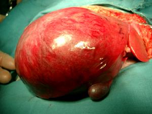 （圖）肝臟錯構瘤