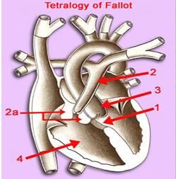 三尖瓣下移畸形